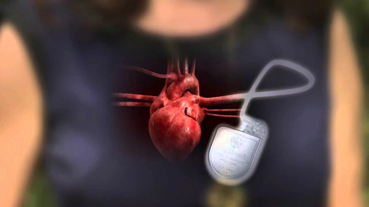Digital illustration of a human heart connected to an implanted pacemaker device