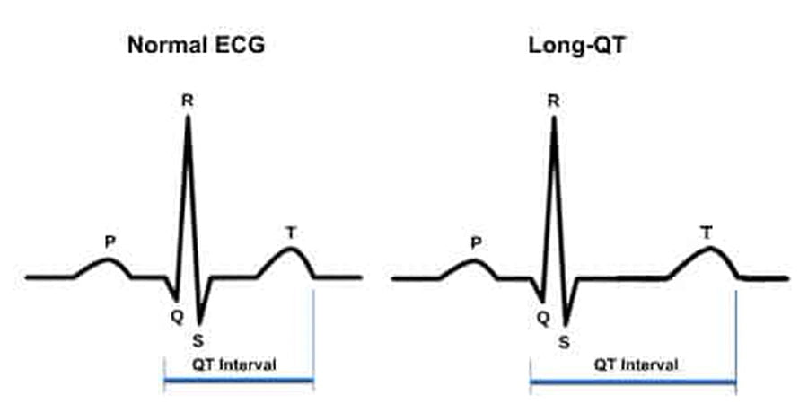 Long QT Syndrome Symptoms and Description of LQTS - Image 2