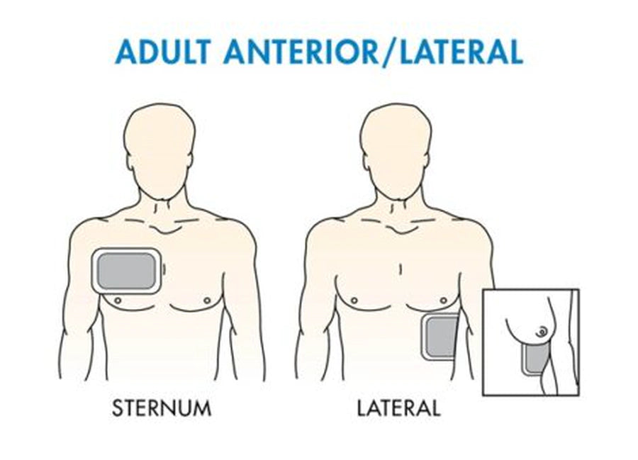 Complete AED Pad Placement Guide: Where to Place AED Electrode Pads On Adults, Children & Infants - Image 2
