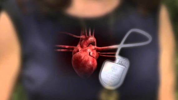 pacemaker